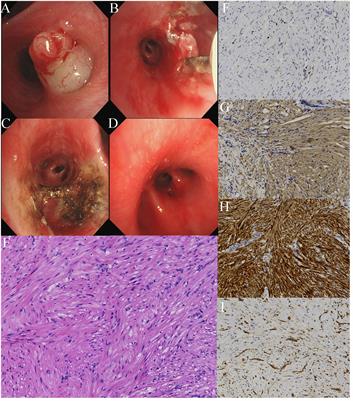 Endoscopic submucosal dissection of endobronchial leiomyoma with a hybrid knife in an adolescent patient: a case report
